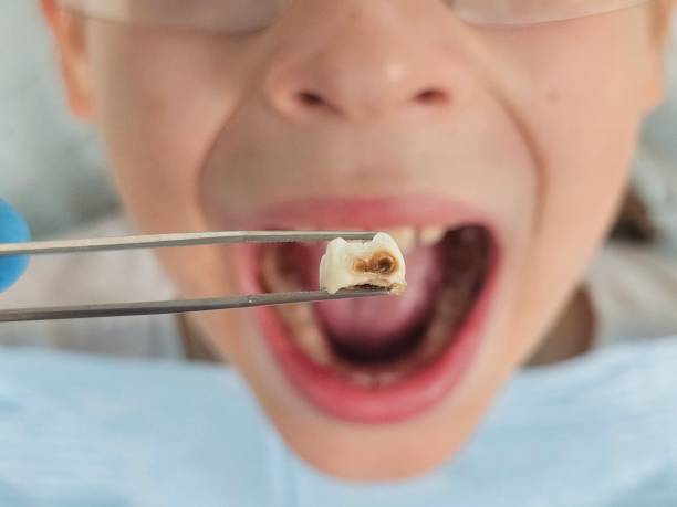 Best Emergency Gum Treatment in Sunset, UT